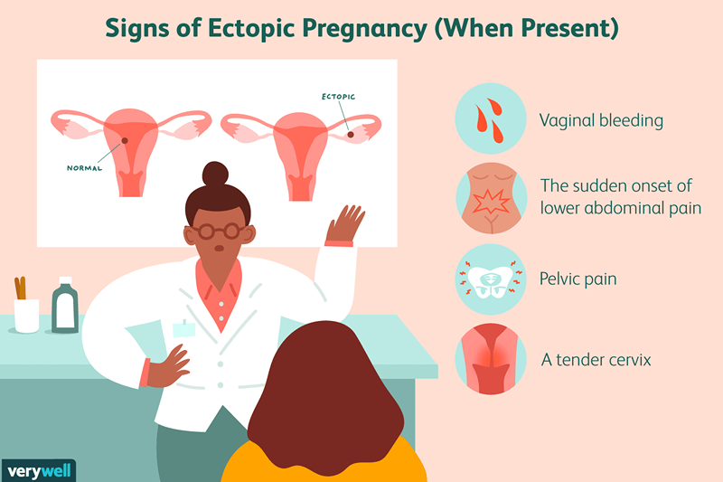 È possibile salvare una gravidanza ectopica?