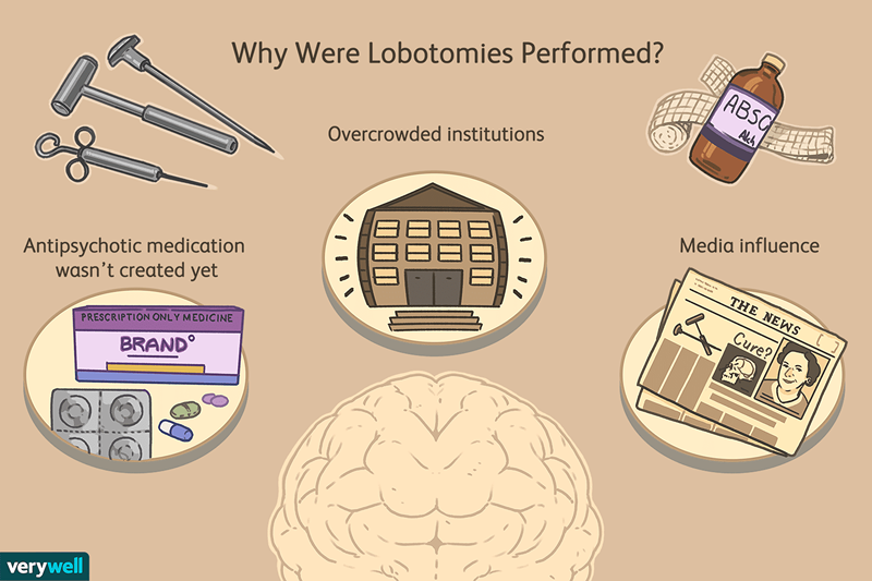 Lobotomia come trattamento per la salute mentale